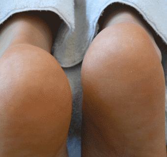 Footlogix manufacturer results photo - after treatment