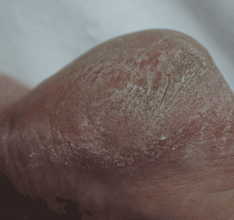 Footlogix manufacturer results photo - before treatment