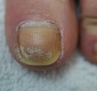 Footlogix manufacturer results photo - before treatment