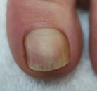 Footlogix manufacturer results photo - after treatment