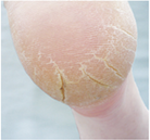 Footlogix manufacturer results photo - before treatment