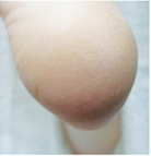 Footlogix manufacturer results photo - after treatment