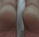 Footlogix manufacturer results photo - before treatment