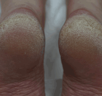 Footlogix manufacturer results photo - before treatment