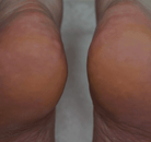 Footlogix manufacturer results photo - after treatment