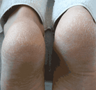 Footlogix manufacturer results photo - before treatment