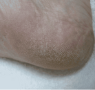 Footlogix manufacturer results photo - before treatment