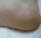 Footlogix manufacturer results photo - after treatment