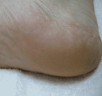 Footlogix manufacturer results photo - after treatment